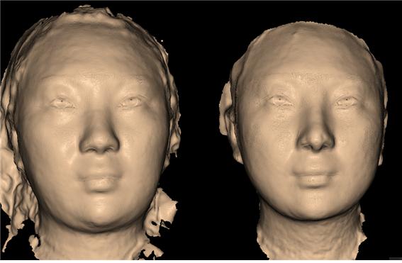 가상성형 , 라이프비즈, 얼굴지방흡입, 양악수술, 3D카메라, 피부과 진료 잘하는 곳, 피부과 치료 잘하는 곳, 강남 피부과, 압구정 피부과, 강남 압구정 피부과, 피부과 전문의, 얼굴지방흡입 치료 잘하는 곳, 지방흡입 잘하는 곳, 강남 피부과 잘하는 곳, 윤곽수술, 윤곽주사, 벨라소닉, 벨라룩스, 벨라팩트, 티셀메드