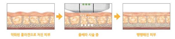 리프팅레이저 , 울쎄라, 초음파시술, 위드윈피부과, 압구정 위드윈 피부과, 압구정 피부과, 강남 피부과, 콜라겐, 재생, 피부재생, 트랜스듀서, 웰츠, 부종, 붓기, 눈가주름, 진피층, 손등, 모공, 피지, 여드름, 피부과 추천, 압구정 피부과 추천, 강남 피부과 추천, 피부과 잘하는 곳