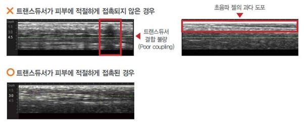 리프팅레이저 , 울쎄라, 초음파시술, 위드윈피부과, 압구정 위드윈 피부과, 압구정 피부과, 강남 피부과, 콜라겐, 재생, 피부재생, 트랜스듀서, 웰츠, 부종, 붓기, 눈가주름, 진피층, 손등, 모공, 피지, 여드름, 피부과 추천, 압구정 피부과 추천, 강남 피부과 추천, 피부과 잘하는 곳