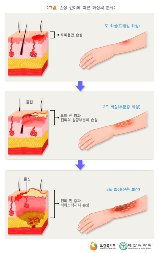 화상치료, 강남 압구정 화상 흉터, 줄기세포배양액, 압구정 흉터 치료, 압구정 화상 치료 잘하는곳, 화상치료 잘하는곳, 흉터치료 잘하는곳, 흉터치료 추천, 화상치료 추천, 압구정 피부과, 위드윈 피부과, 티셀메드, 메디컬 그룹, 압구정동 피부과, 강남 피부과, 위드윈 피부과